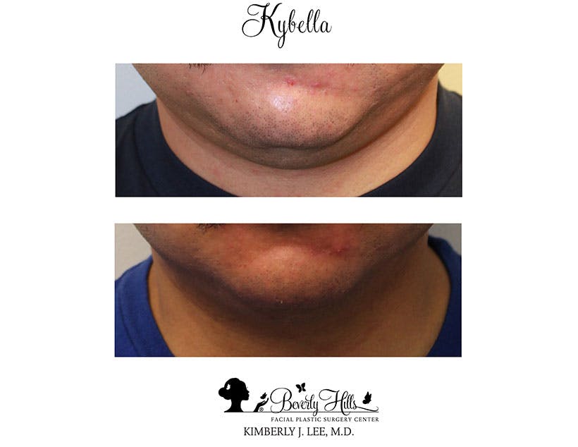 Kybella Before & After Gallery - Patient 85944756 - Image 1
