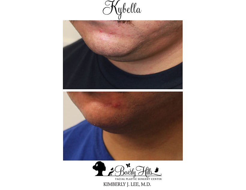 Kybella Before & After Gallery - Patient 85944756 - Image 2