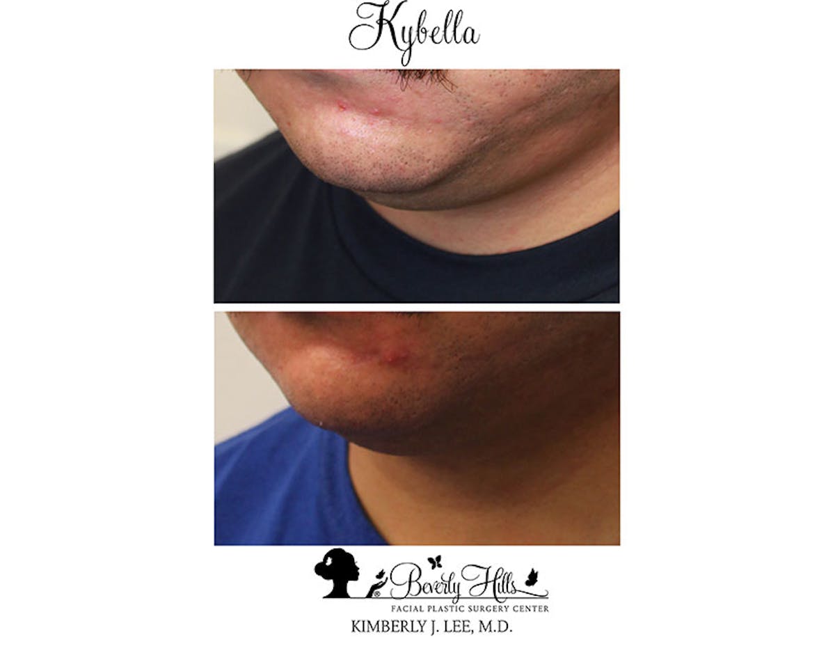 Kybella Before & After Gallery - Patient 85944756 - Image 2