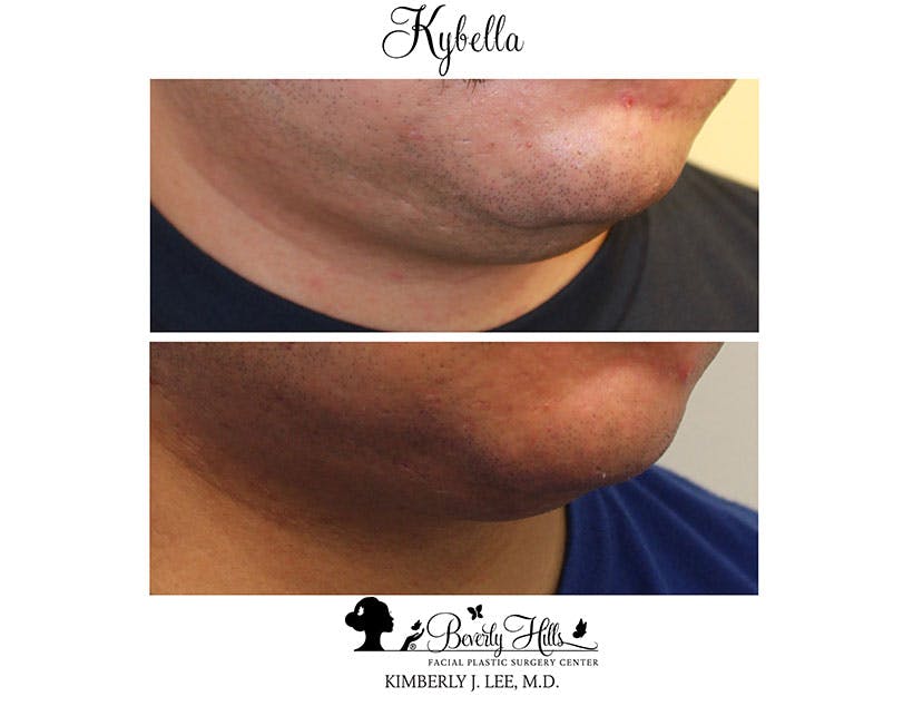 Kybella Before & After Gallery - Patient 85944756 - Image 3