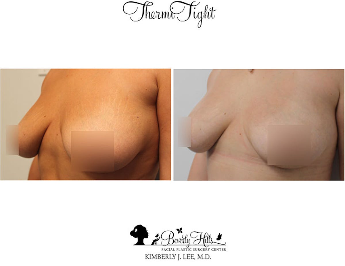 Thermitight Before & After Gallery - Patient 85944769 - Image 3