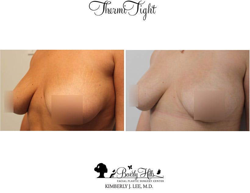Thermitight Before & After Gallery - Patient 85944769 - Image 3