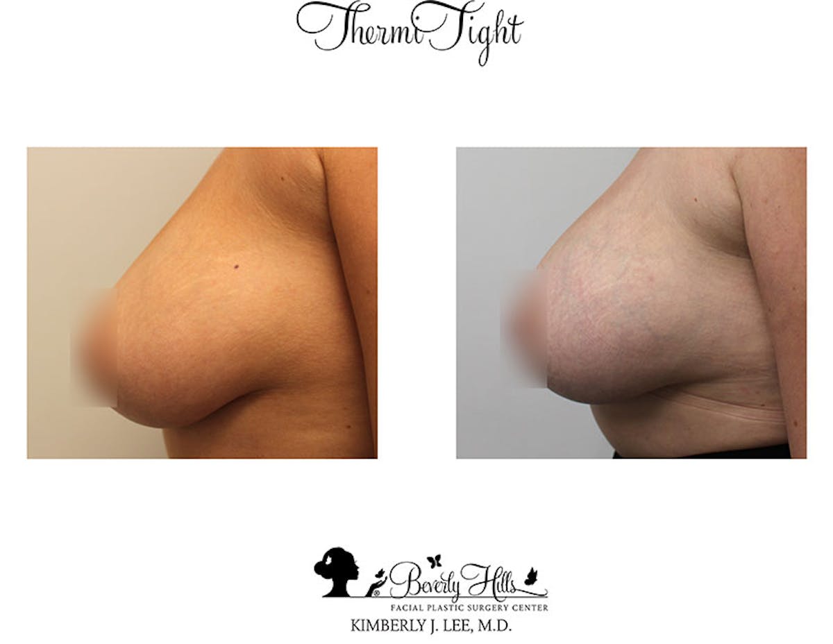 Thermitight Before & After Gallery - Patient 85944769 - Image 2