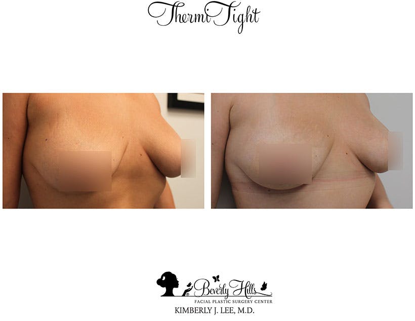 Thermitight Before & After Gallery - Patient 85944769 - Image 1