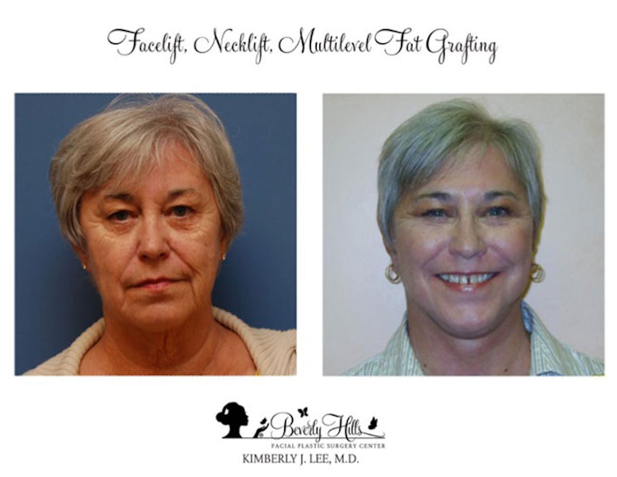 Facelift Before & After Gallery - Patient 85944774 - Image 1