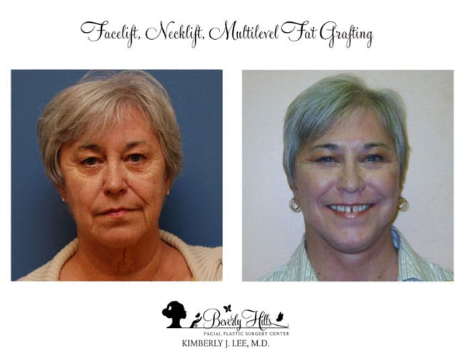 Mini-Facelift in Beverly Hills Before & After Photos