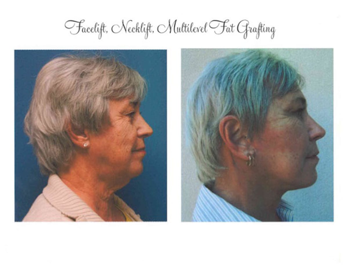 Facelift Before & After Gallery - Patient 85944774 - Image 2