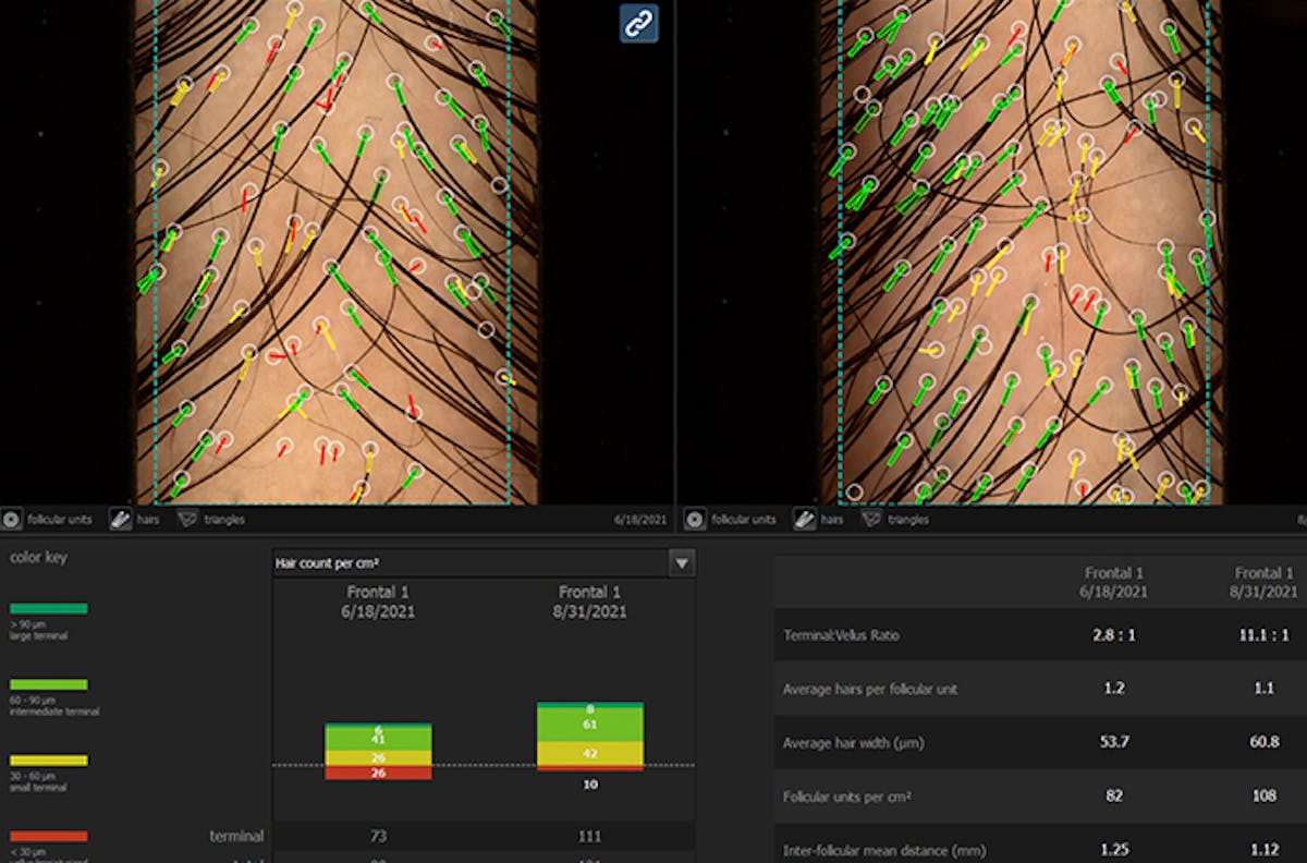 Hair Before & After Gallery - Patient 85944785 - Image 1