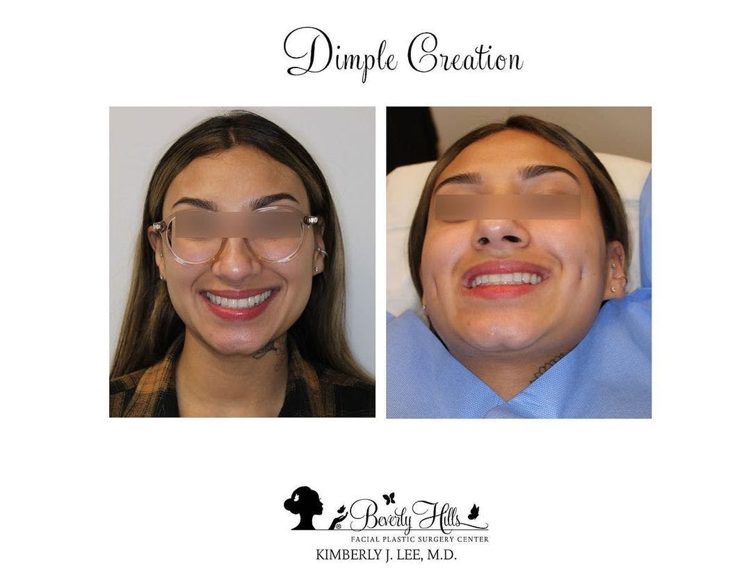 Dimple Creation Gallery - Patient 89936311 - Image 1