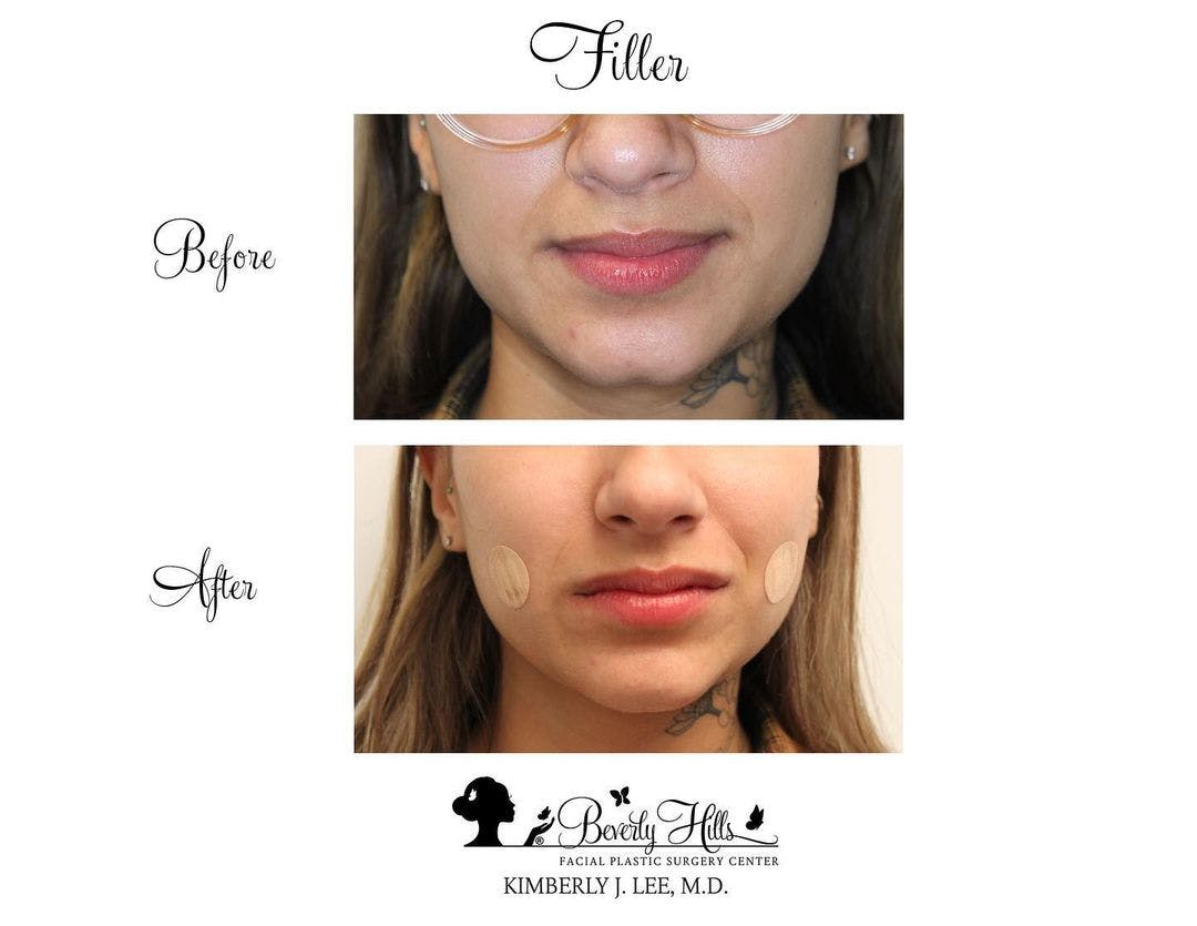 Non-Surgical Chin Augmentation Before & After Gallery - Patient 89936477 - Image 1