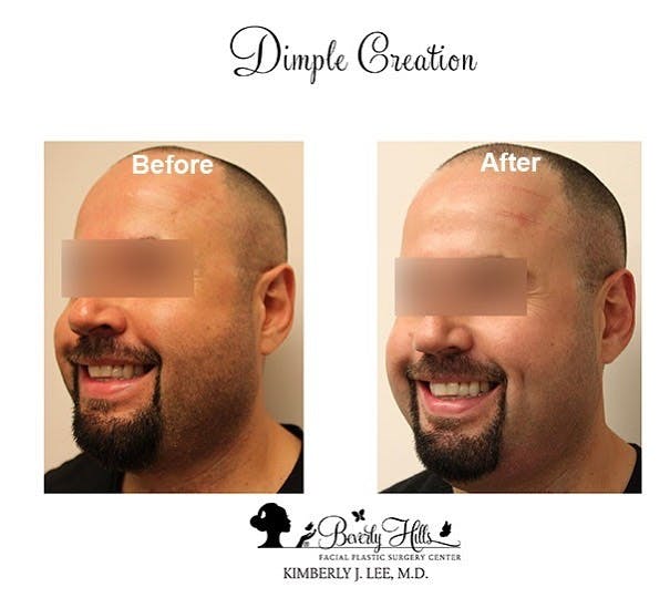 Dimple Creation Gallery - Patient 85939983 - Image 2