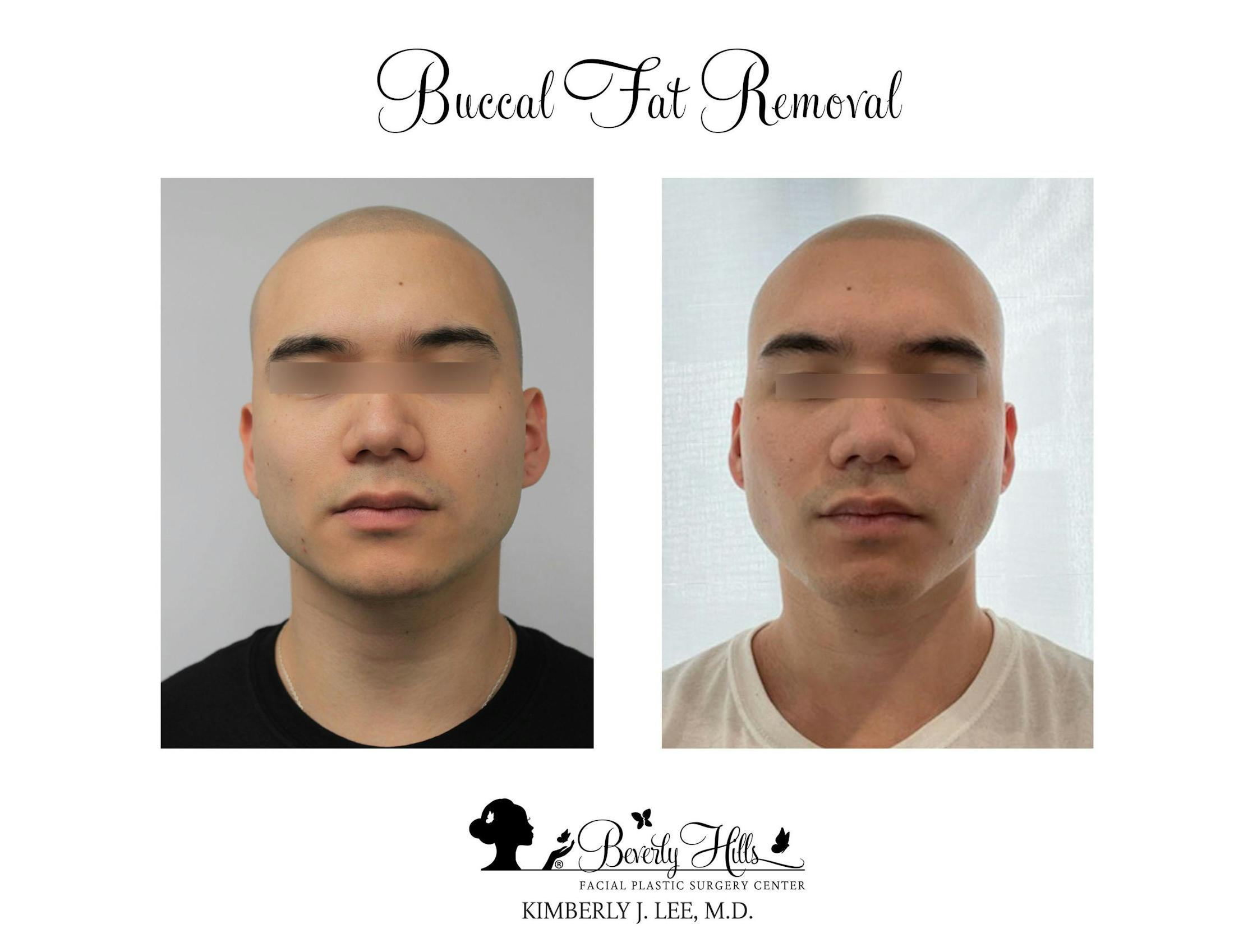 Buccal Fat Removal Before & After Gallery - Patient 142881283 - Image 1