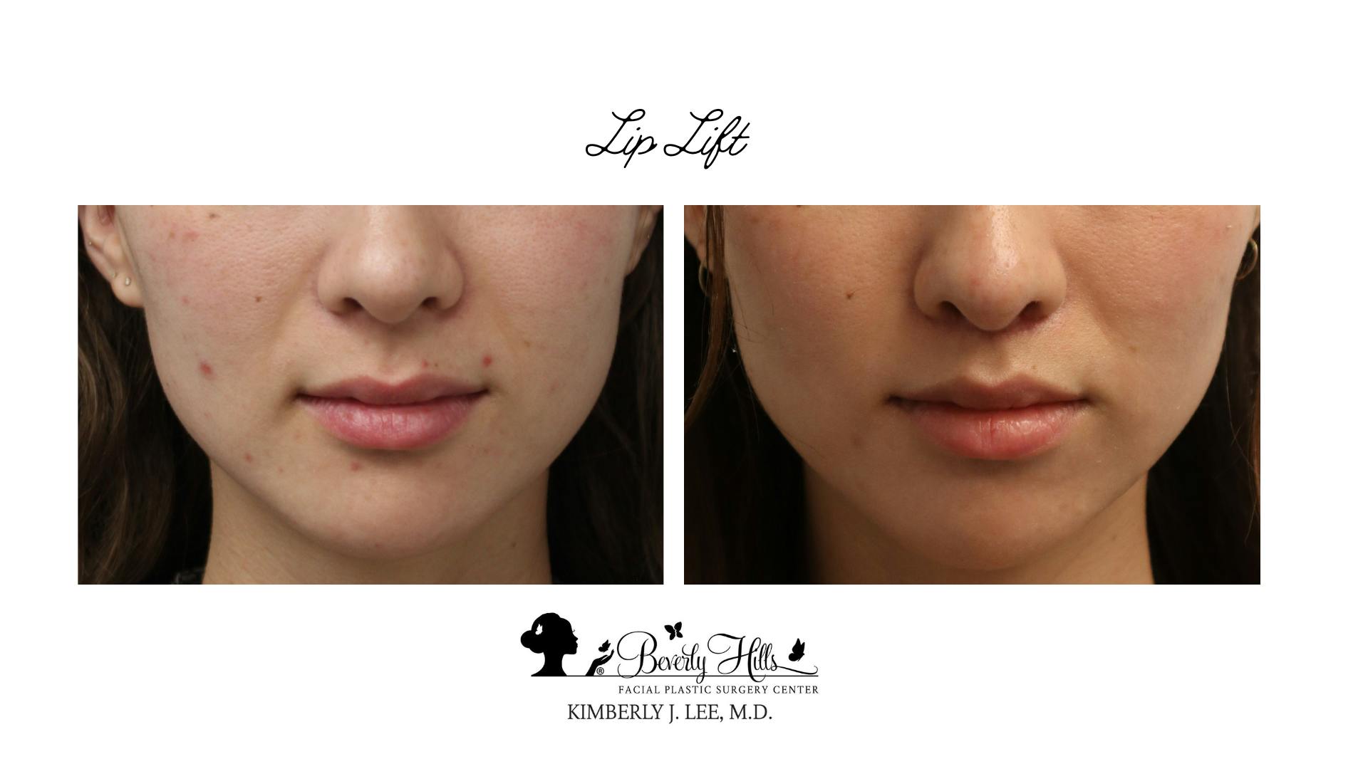 Lips Before & After Gallery - Patient 142881290 - Image 1