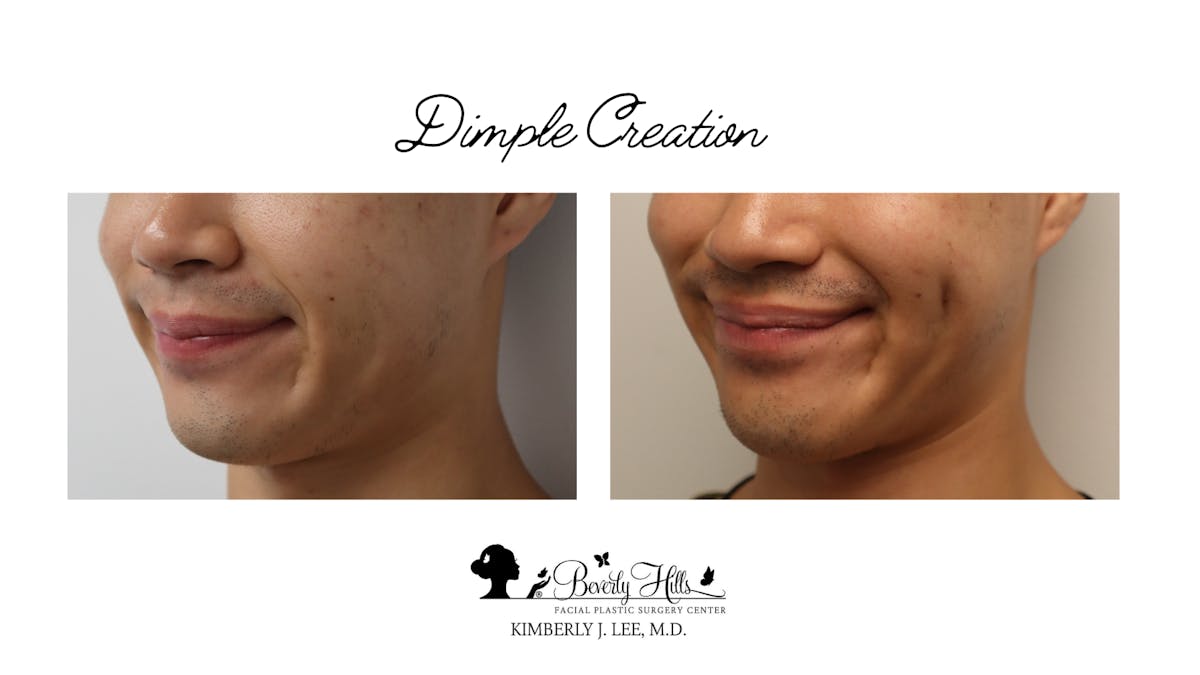 Dimple Creation Before & After Gallery - Patient 142881292 - Image 1