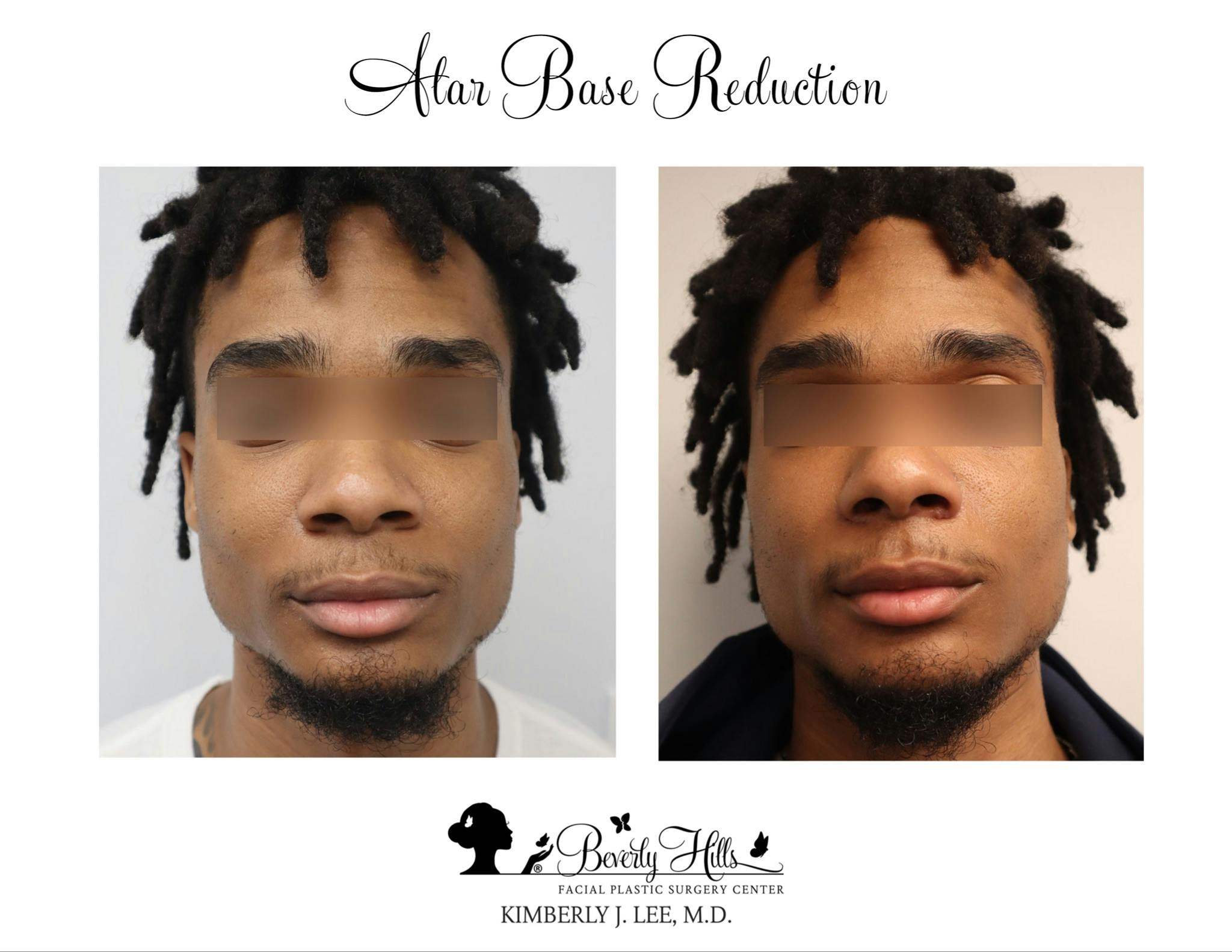 Rhinoplasty Before & After Gallery - Patient 142881293 - Image 1