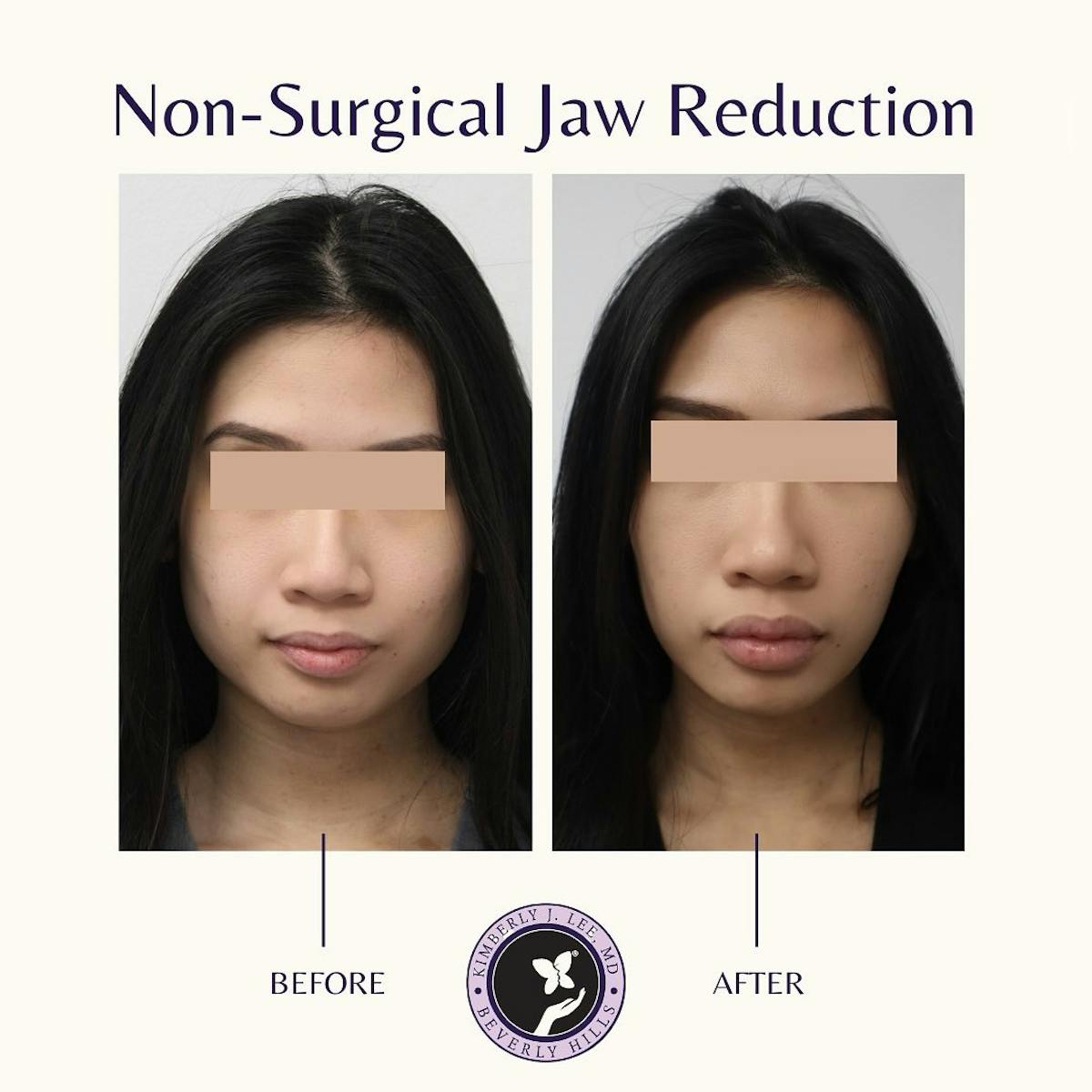 Jaw Contouring Before & After Gallery - Patient 143021014 - Image 1