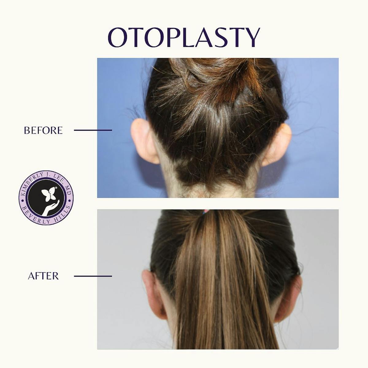 Otoplasty </br> (Ear Surgery)  Before & After Gallery - Patient 143021019 - Image 1