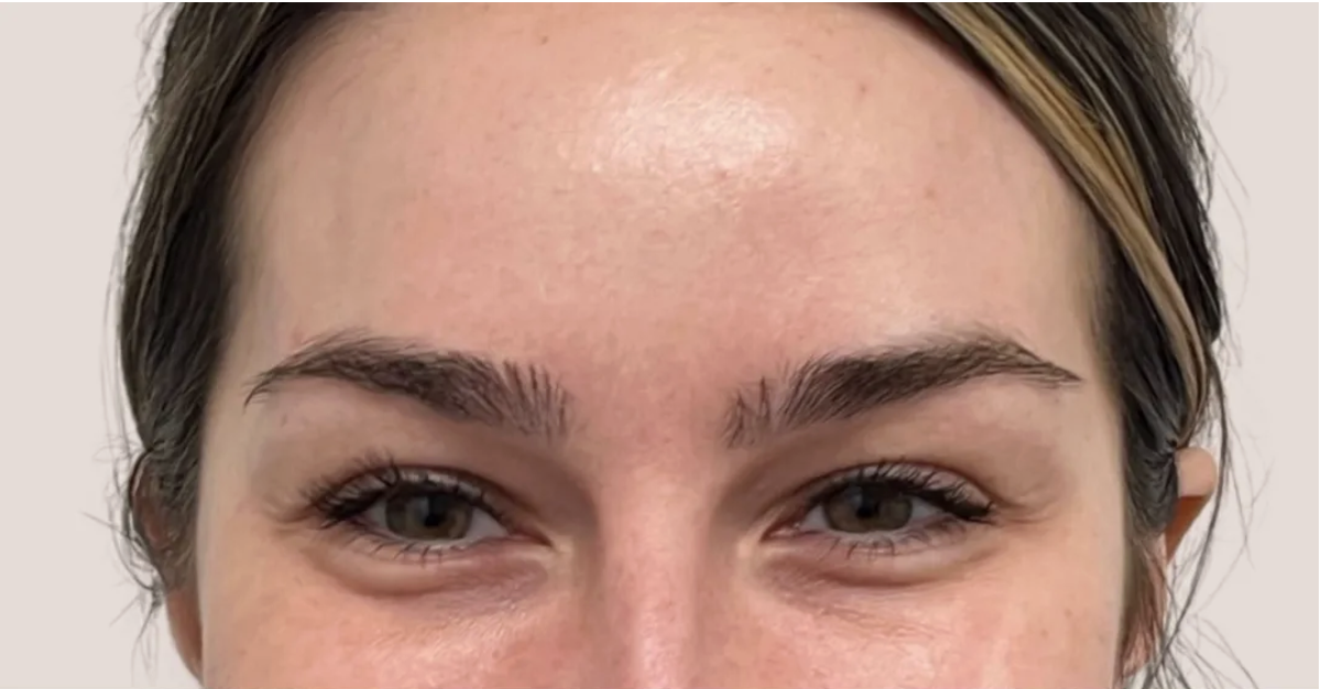 BOTOX in Los Angeles and Beverly Hills Before Photo