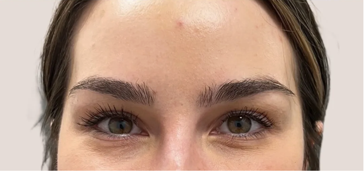 BOTOX in Los Angeles and Beverly Hills After Photo