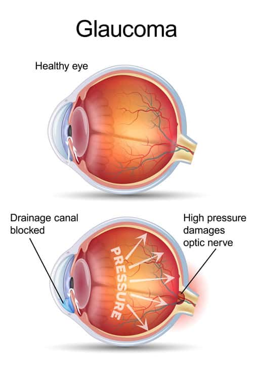 Glaucoma diagram