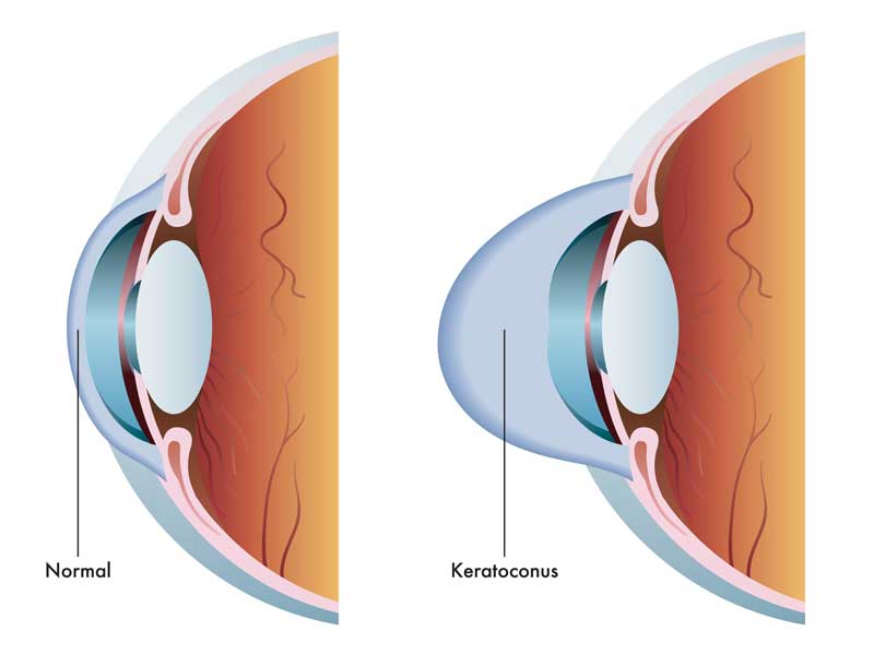 iLink™ corneal cross-linking image