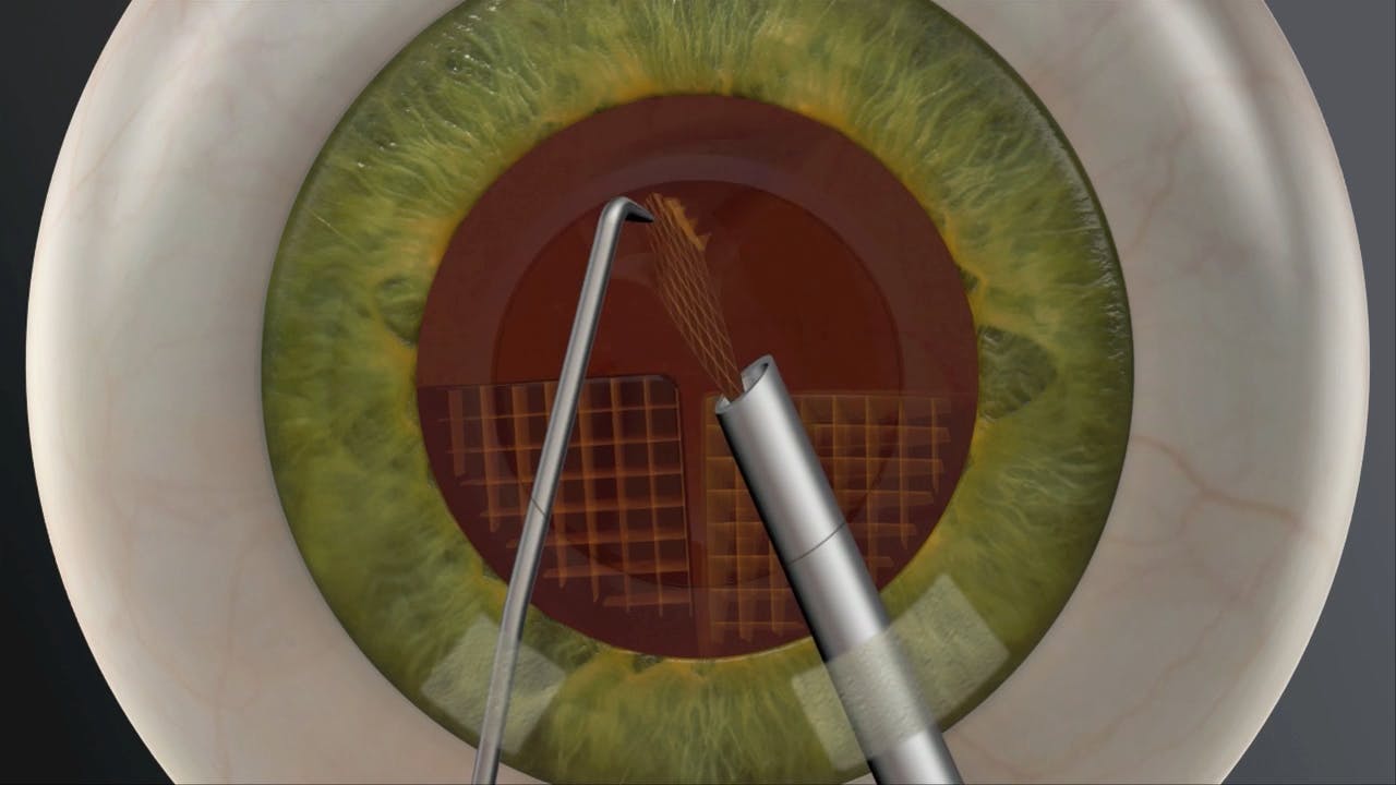 Cataract surgery animation image