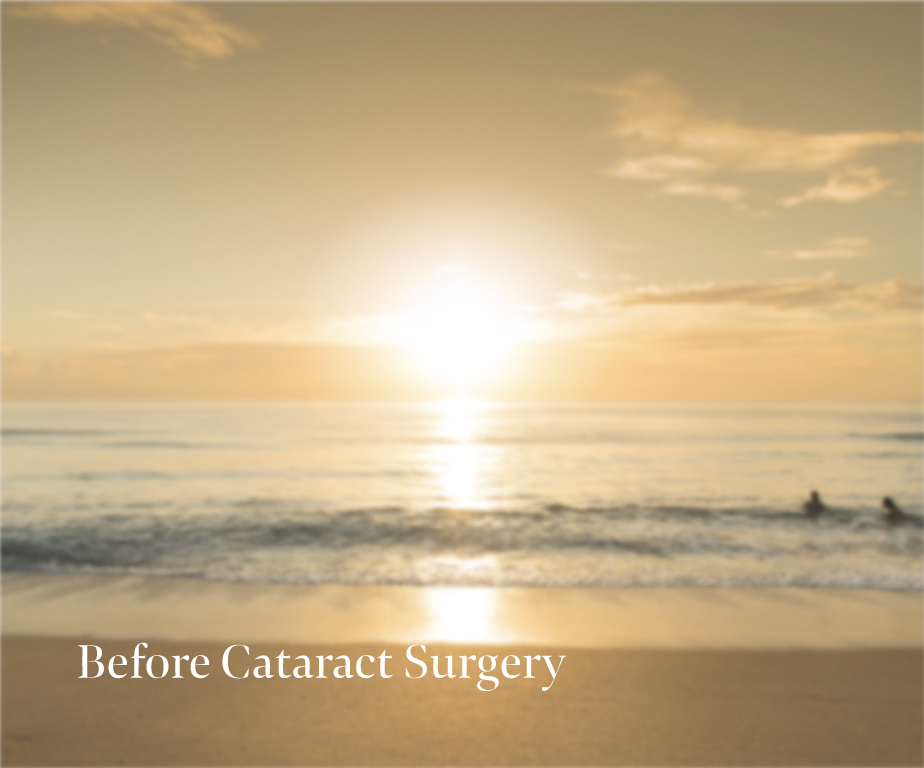 Halos before cataract surgery with picture of two people in ocean at beach