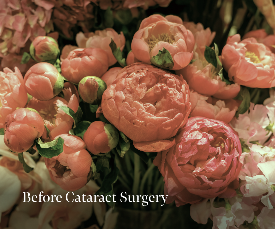 Color Distortion before cataract surgery with picture of flowers