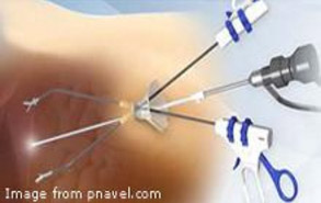 Single Incision (Scarless) Surgery (SILS)