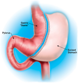 gastric sleeve