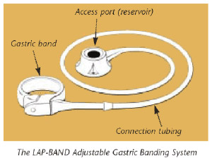 lap band diagram