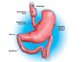 gastrectomy