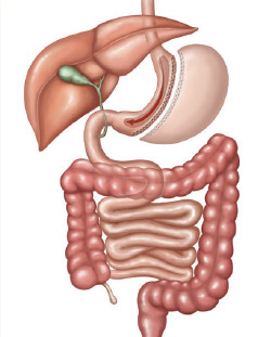 Sleeve Gastrectomy