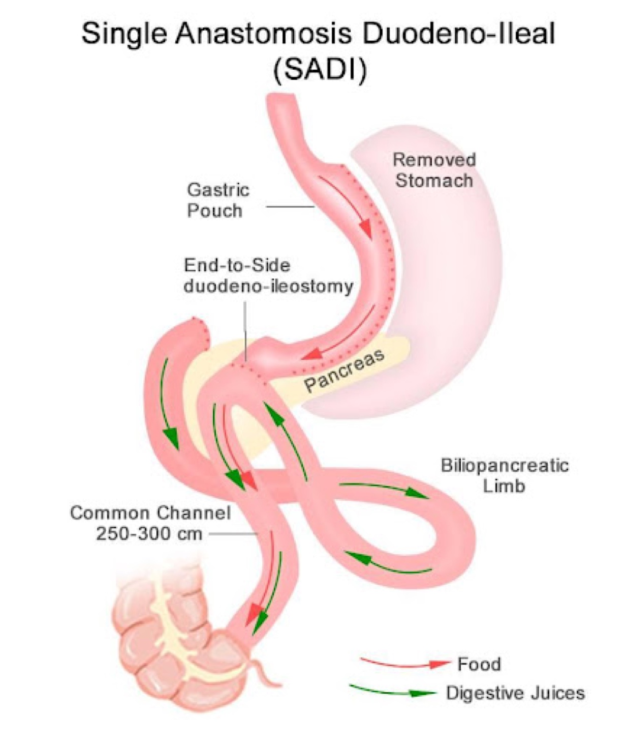 SADI diagram