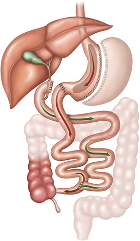 Biliopancreatic Diversion With Duodenal Switch