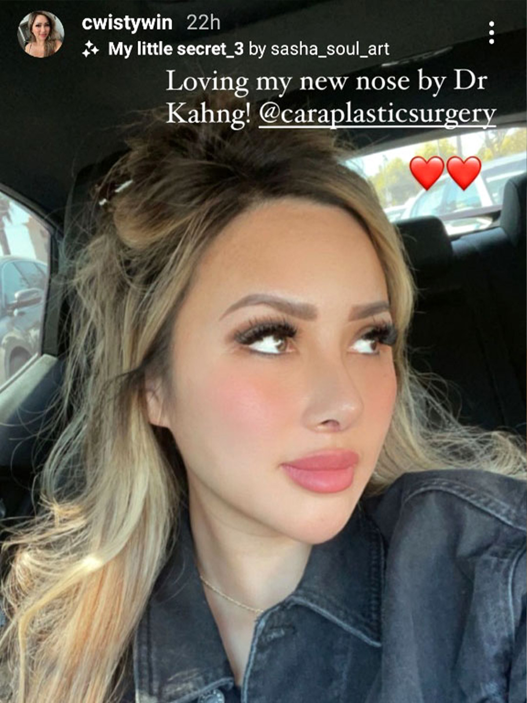 instagram picture of a patient's new nose after rhinoplasty in Los Angeles & Orange County