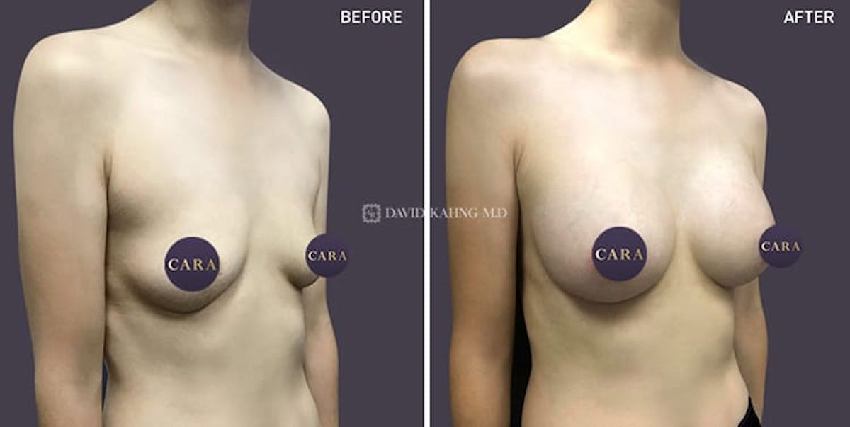 Breast Augmentation Before & After Gallery - Patient 108464475 - Image 1