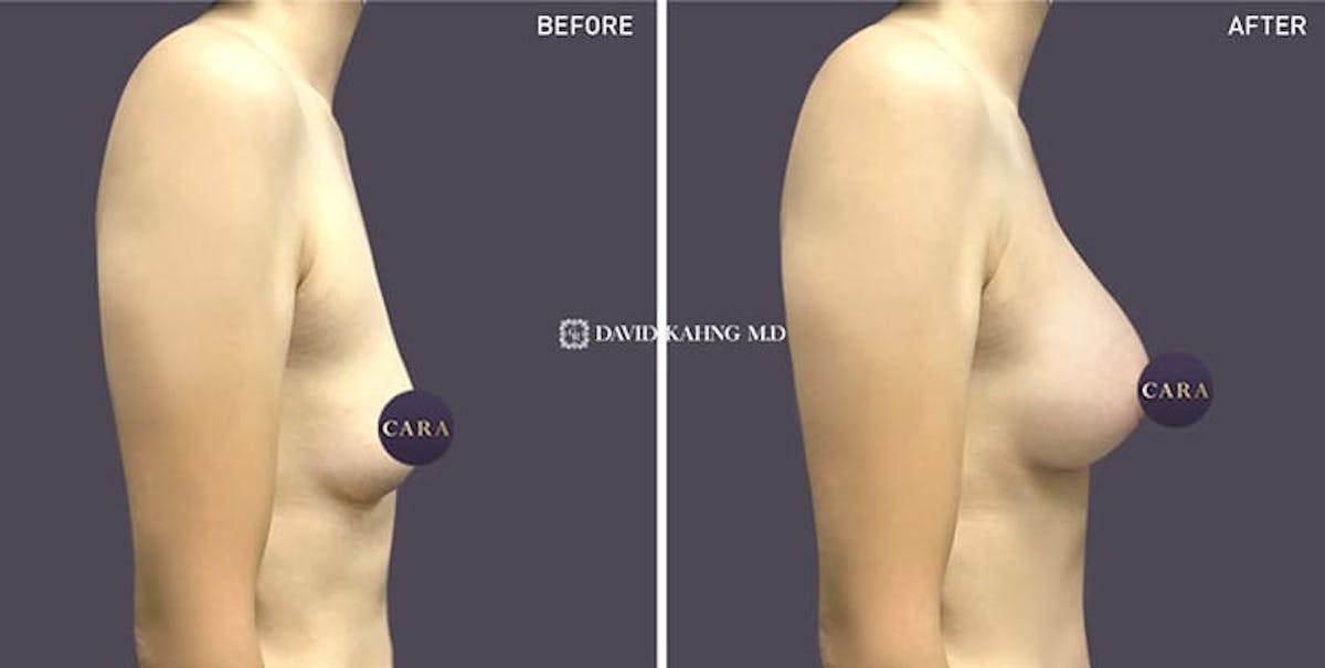 Breast Augmentation Before & After Gallery - Patient 108464476 - Image 1
