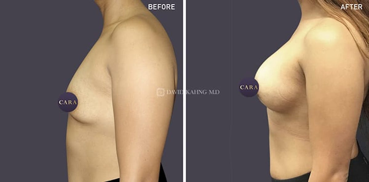 Breast Augmentation Before & After Gallery - Patient 108464478 - Image 1