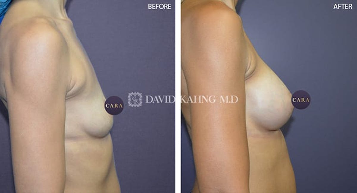Breast Augmentation Before & After Gallery - Patient 108464480 - Image 1