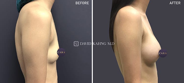 Breast Augmentation Before & After Gallery - Patient 108464482 - Image 1