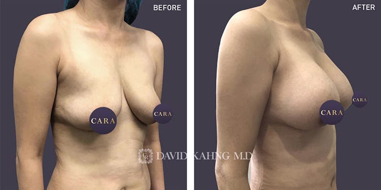 Breast Augmentation Before & After Gallery - Patient 108464483 - Image 1