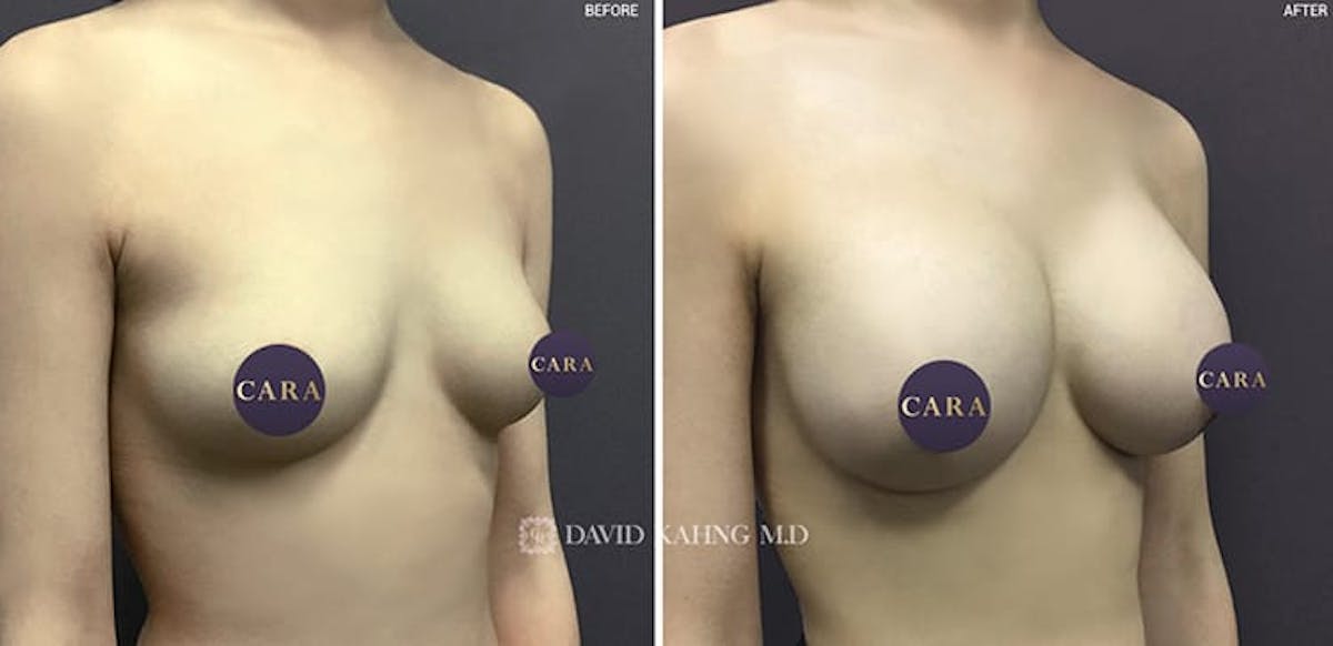 Breast Augmentation Before & After Gallery - Patient 108464484 - Image 1