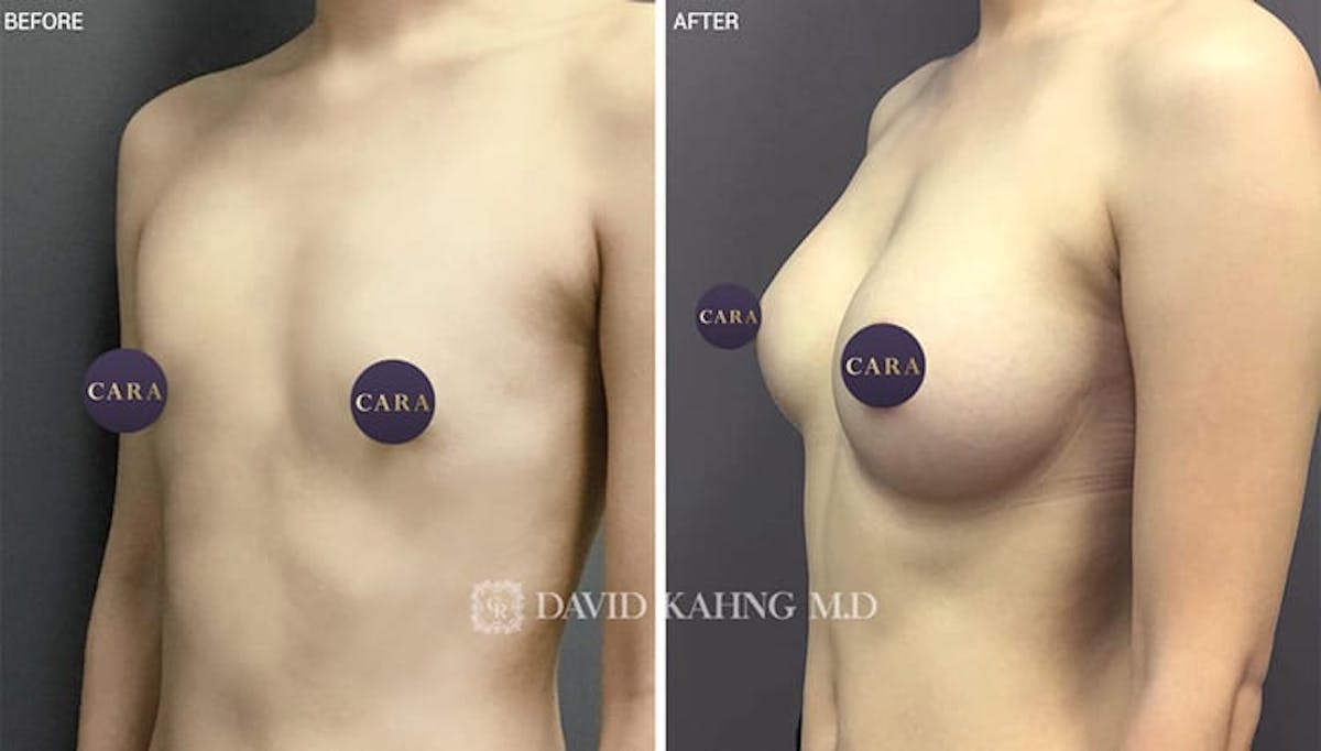 Breast Augmentation Before & After Gallery - Patient 108464486 - Image 1