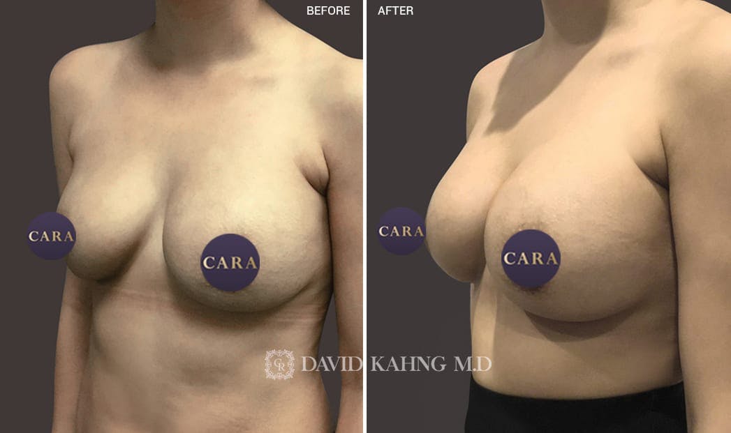 Breast Augmentation Gallery - Patient 108464487 - Image 1