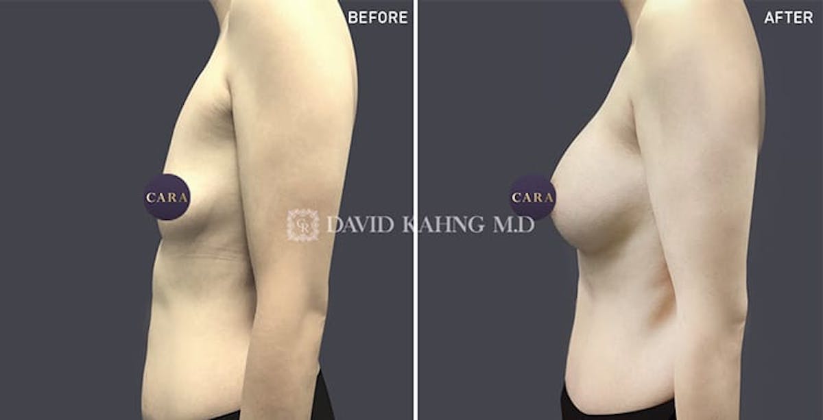 Breast Augmentation Before & After Gallery - Patient 108464488 - Image 1