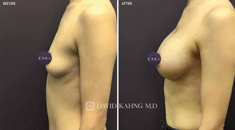 Breast Augmentation Before & After Gallery - Patient 108464474 - Image 1