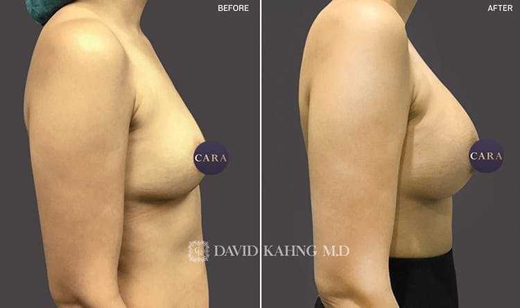 Breast Augmentation Gallery - Patient 108464490 - Image 1