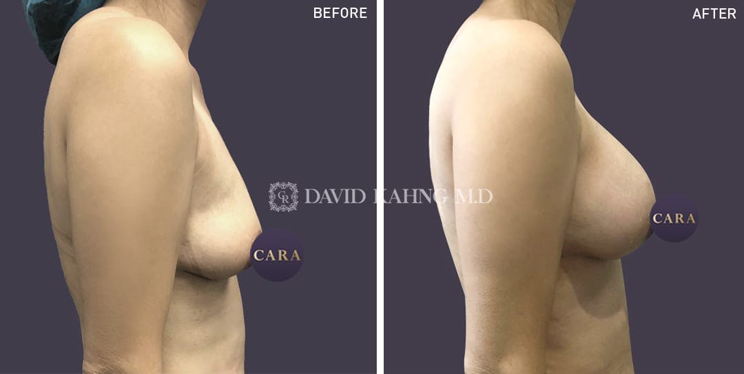 Breast Augmentation Before & After Gallery - Patient 108464491 - Image 1