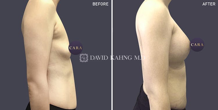 Breast Augmentation Before & After Gallery - Patient 108464492 - Image 1